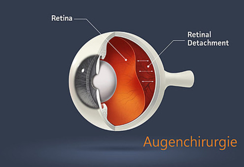 Netzhaut Operation