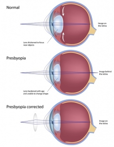 Bei der Altersweitsichtigkeit (Presbyopie) nimmt die Flexibilität der Linse ab. Diese kann das einfallende Licht nicht mehr auf der Netzhaut bündeln. Eine Brille ist eine Möglichkeit der Korrektur, jedoch gibt es auch operative Möglichkeiten.